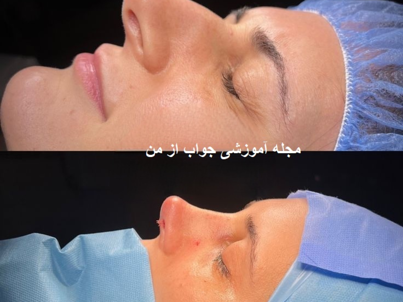 جراحی_بینی4