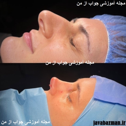 جراحی_بینی4