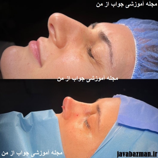 جراحی_بینی4