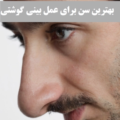 بهترین سن برای عمل بینی گوشتی