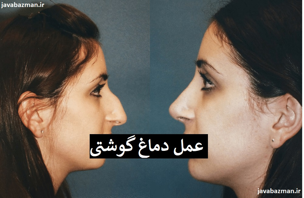 عمل دماغ گوشتی