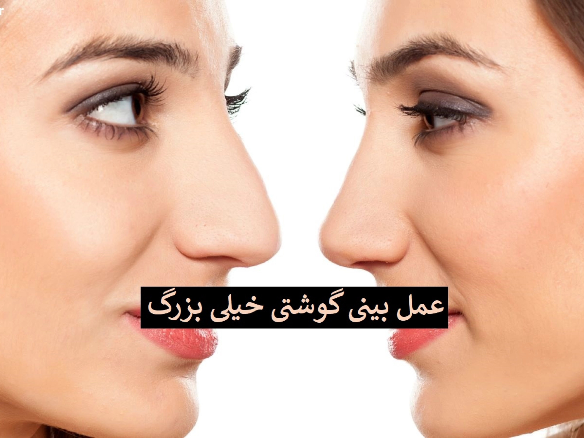 عمل بینی گوشتی خیلی بزرگ