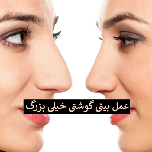 عمل بینی گوشتی خیلی بزرگ