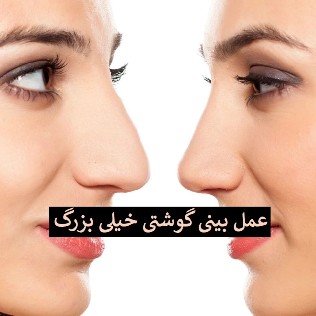 عمل بینی گوشتی خیلی بزرگ