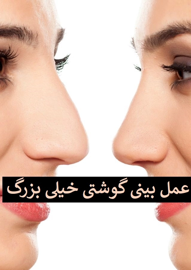 عمل بینی گوشتی خیلی بزرگ