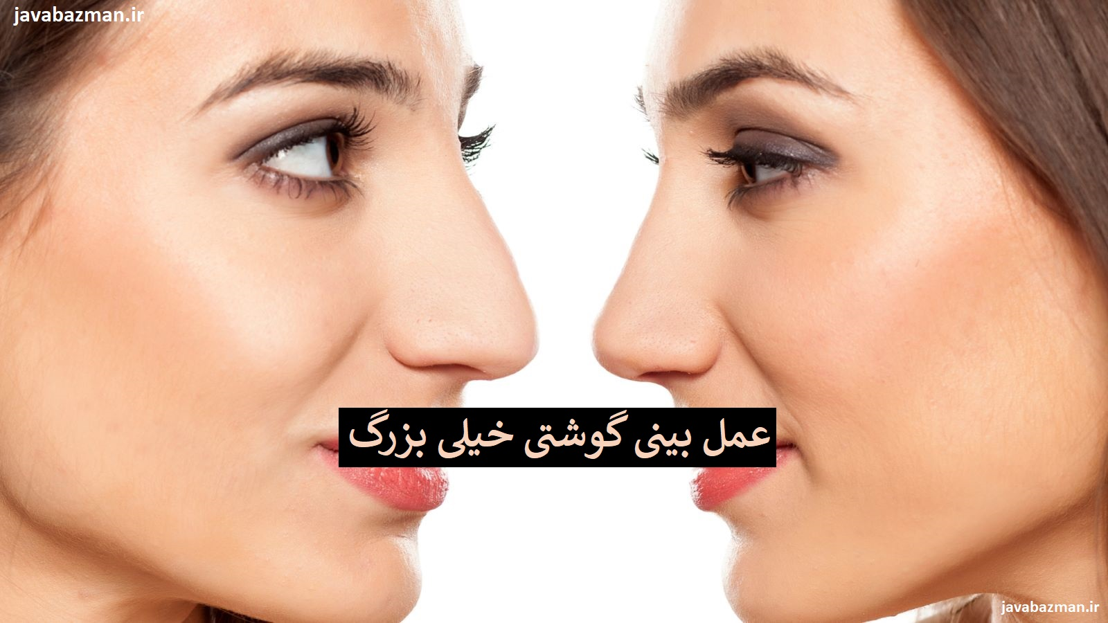 عمل بینی گوشتی خیلی بزرگ