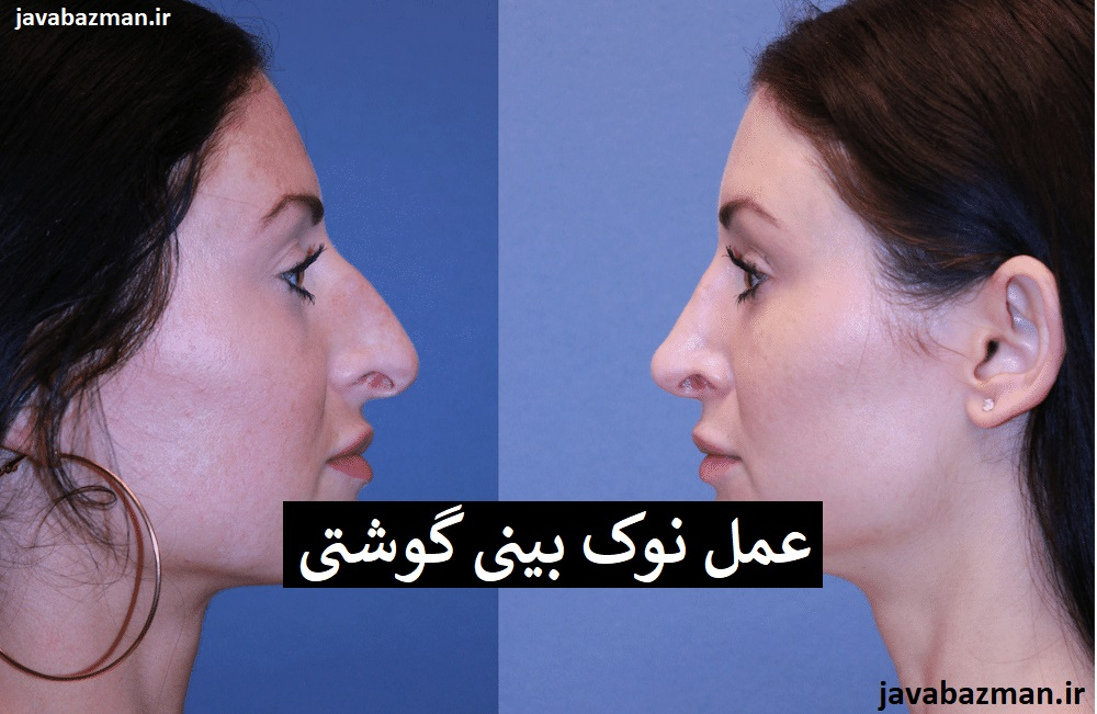 عمل نوک بینی گوشتی