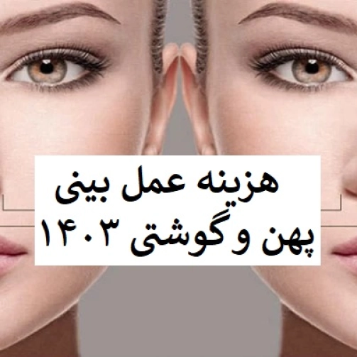 هزینه عمل بینی پهن و گوشتی ۱۴۰۳