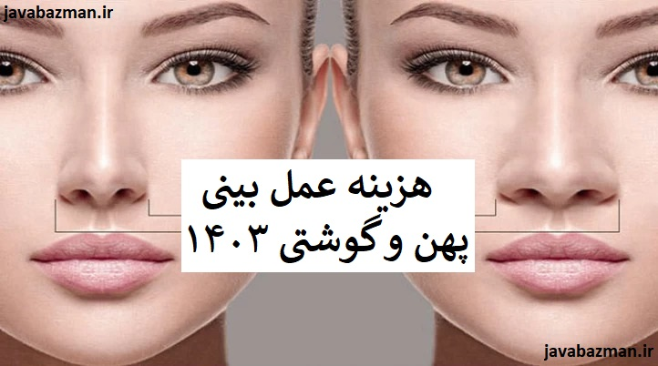 هزینه عمل بینی پهن و گوشتی ۱۴۰۳