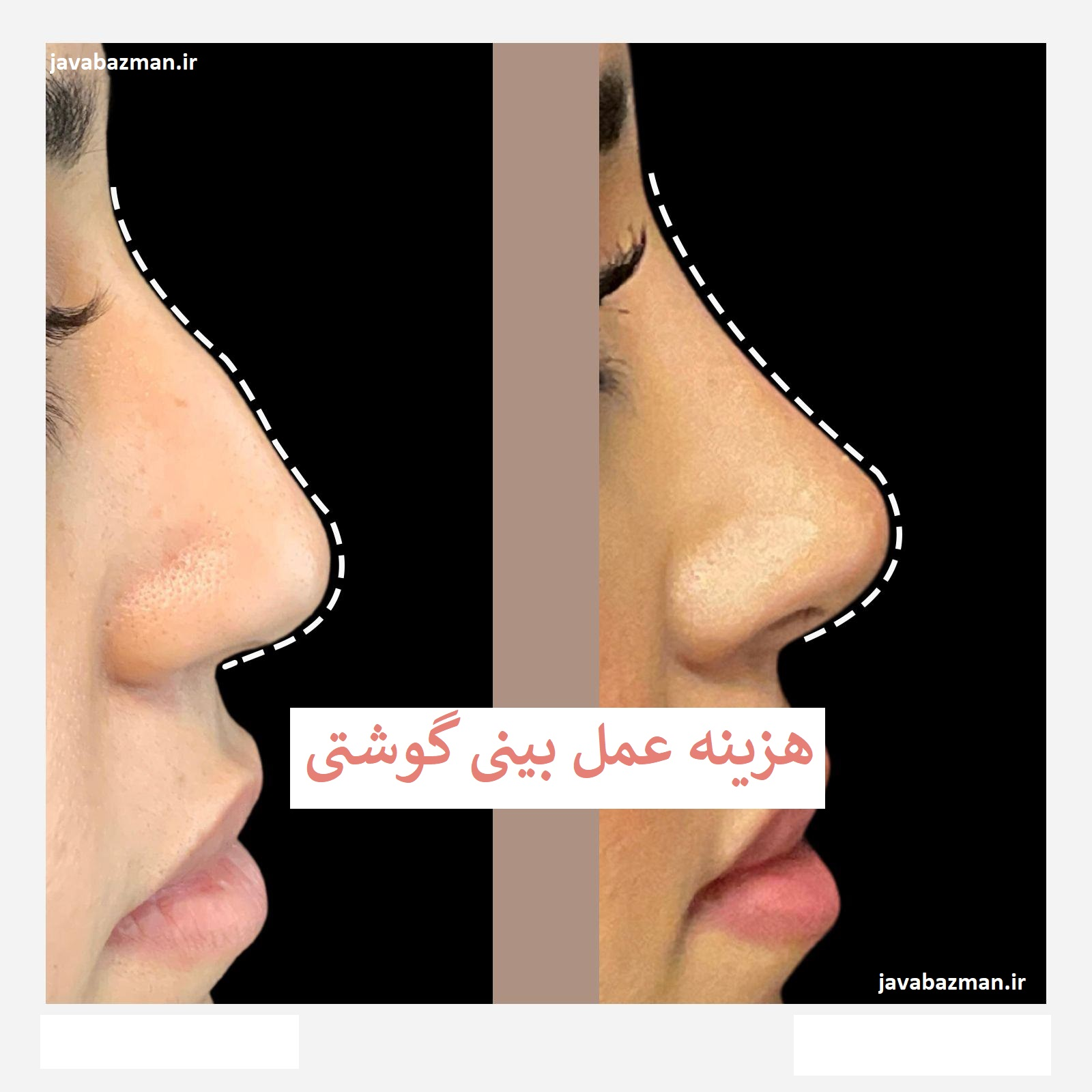 هزینه عمل بینی گوشتی