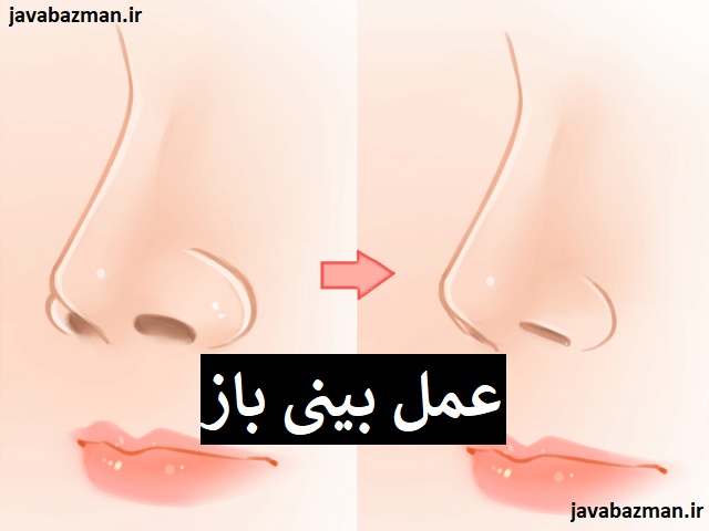 عمل بینی باز