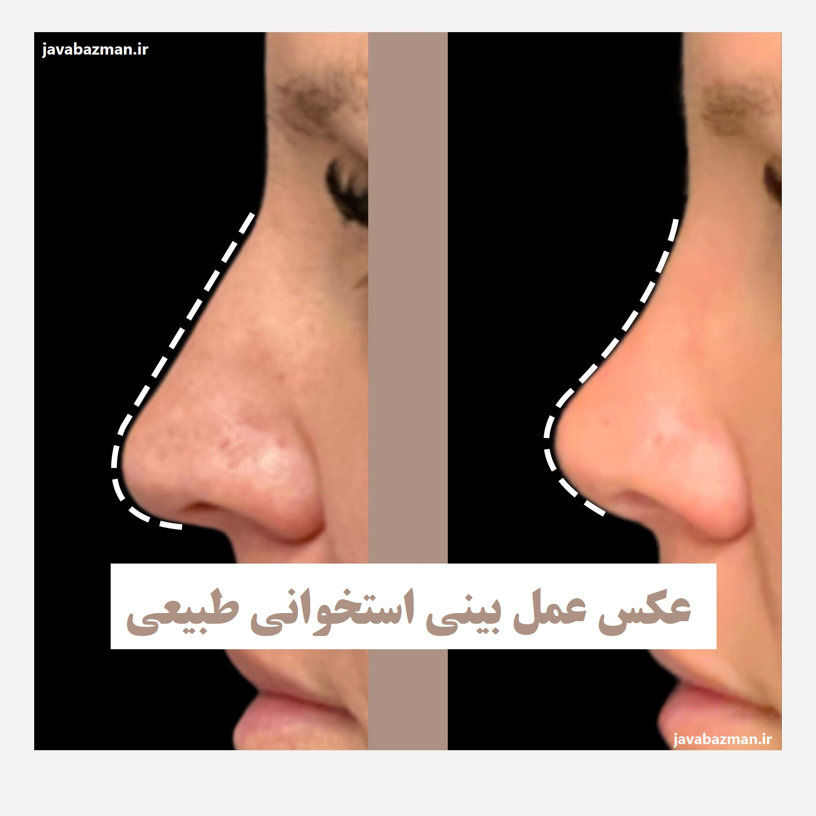 عکس عمل بینی استخوانی طبیعی