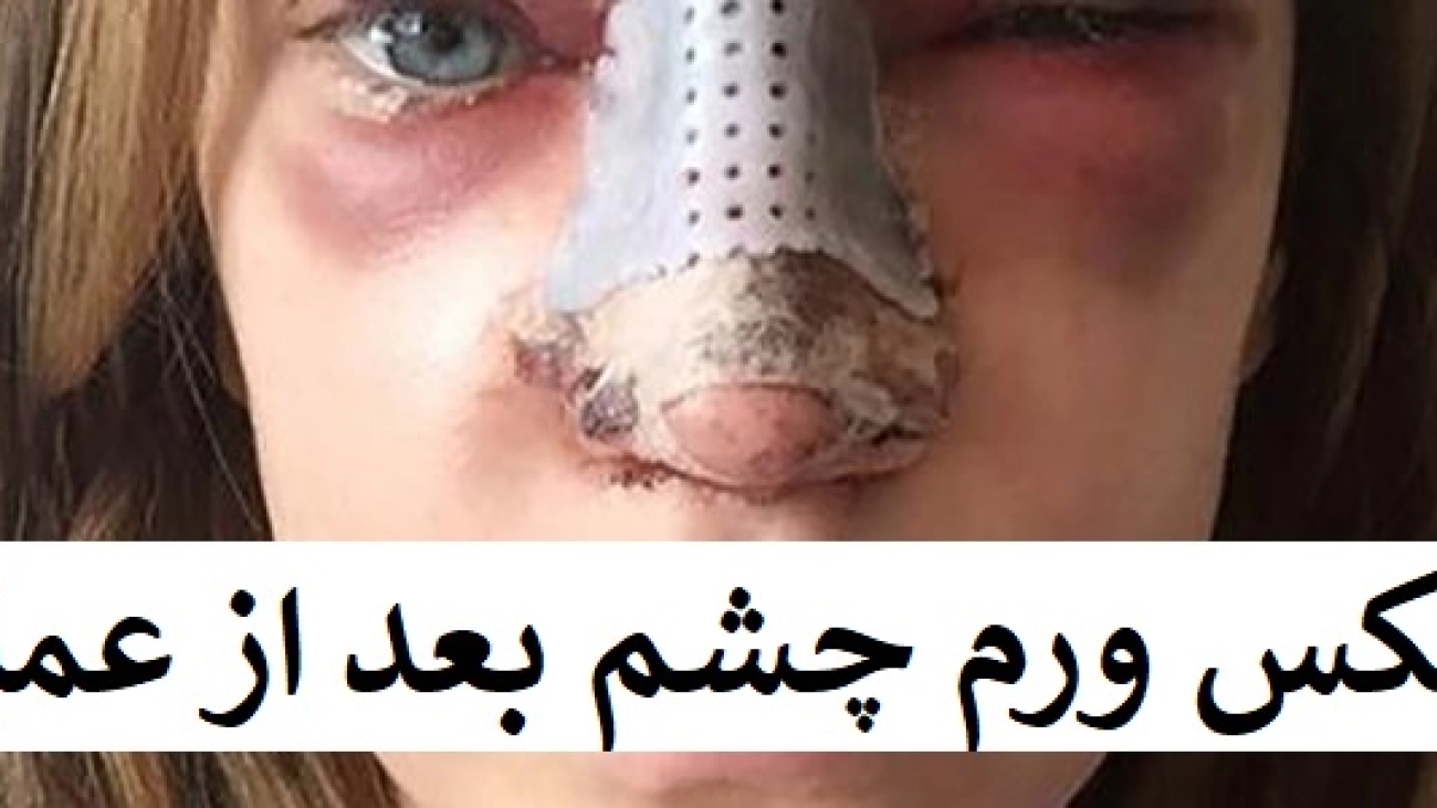 عکس ورم چشم بعد از عمل بینی