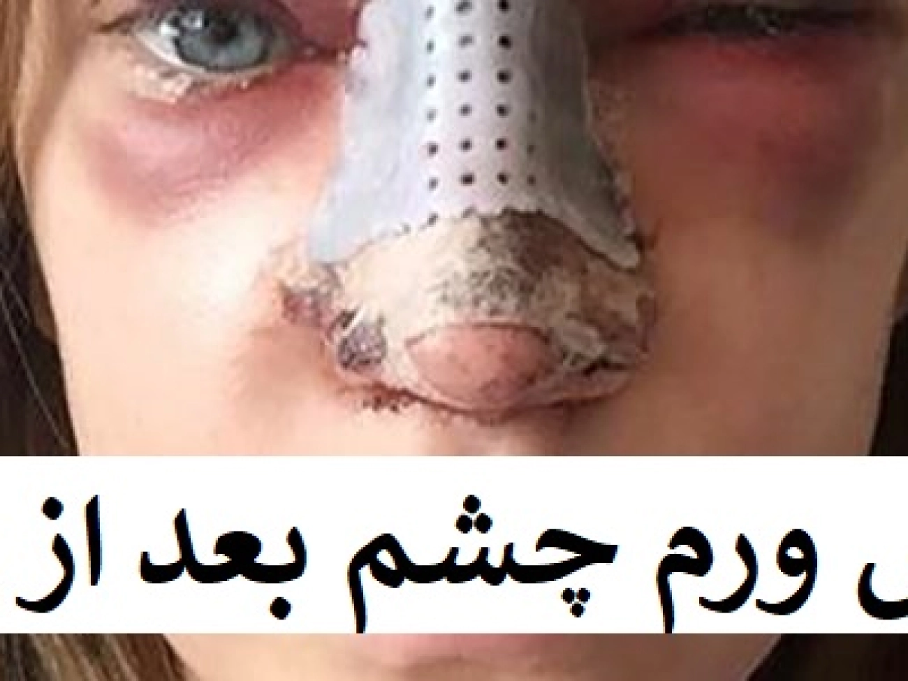 عکس ورم چشم بعد از عمل بینی