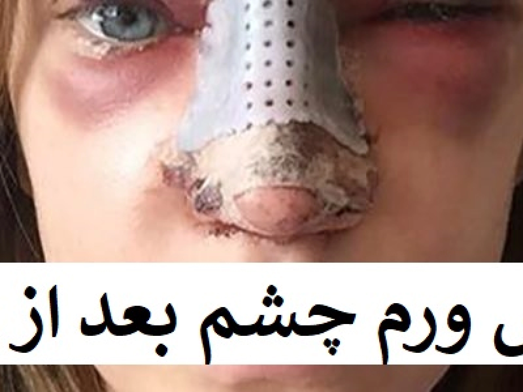 عکس ورم چشم بعد از عمل بینی