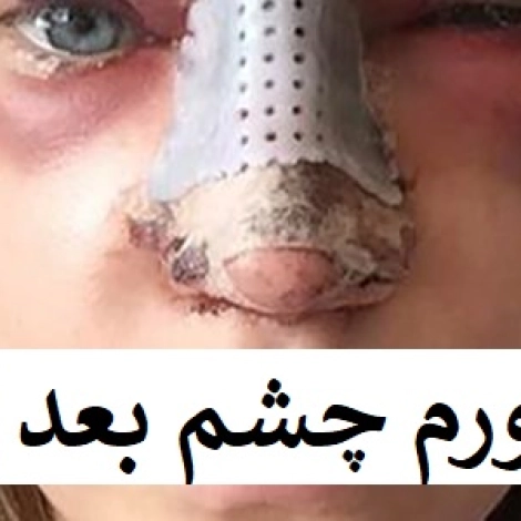 عکس ورم چشم بعد از عمل بینی