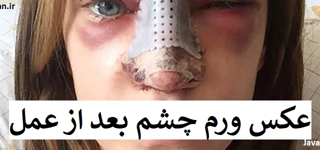 عکس ورم چشم بعد از عمل بینی