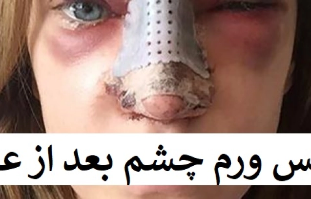 عکس ورم چشم بعد از عمل بینی
