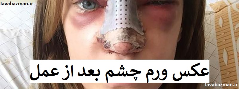 عکس ورم چشم بعد از عمل بینی