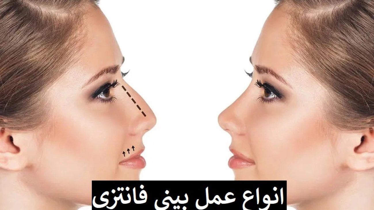 انواع عمل بینی فانتزی