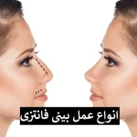 انواع عمل بینی فانتزی