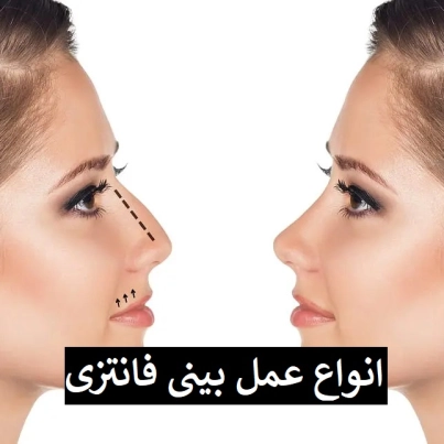 انواع عمل بینی فانتزی