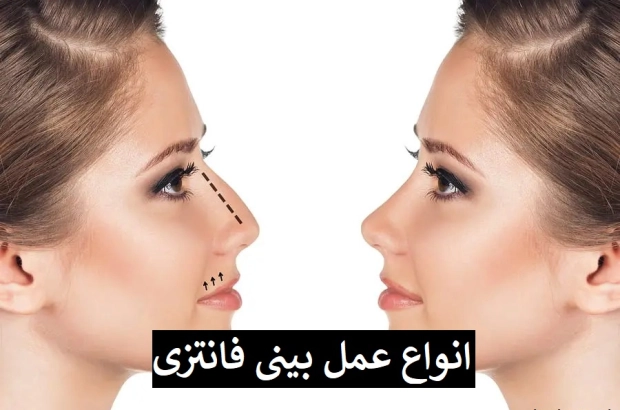 انواع عمل بینی فانتزی