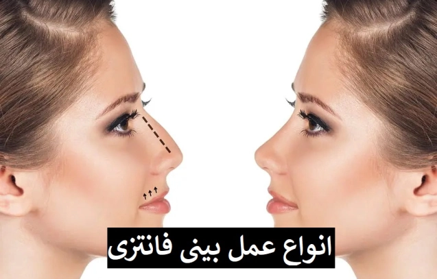 انواع عمل بینی فانتزی