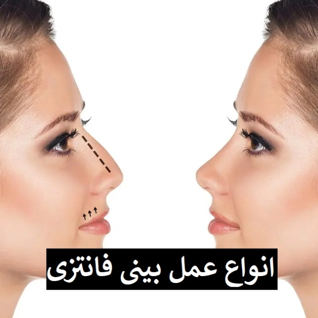 انواع عمل بینی فانتزی