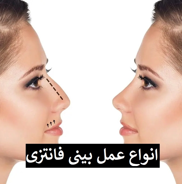 انواع عمل بینی فانتزی