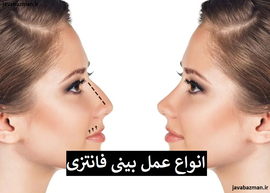 انواع عمل بینی فانتزی