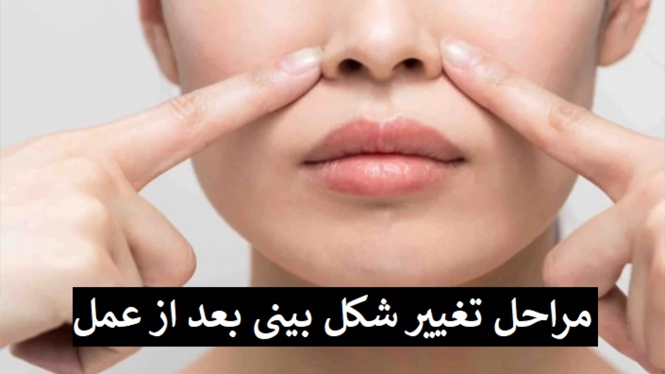 مراحل تغییر شکل بینی بعد از عمل