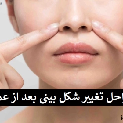 مراحل تغییر شکل بینی بعد از عمل