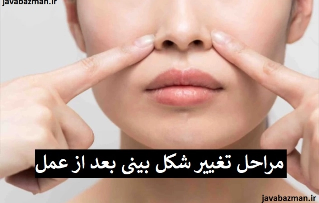 مراحل تغییر شکل بینی بعد از عمل