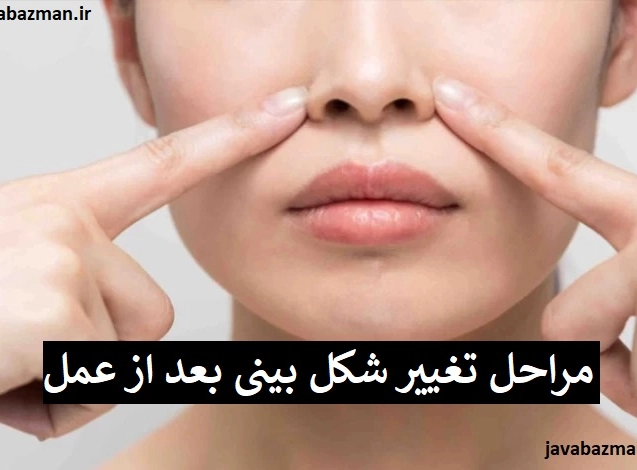 مراحل تغییر شکل بینی بعد از عمل