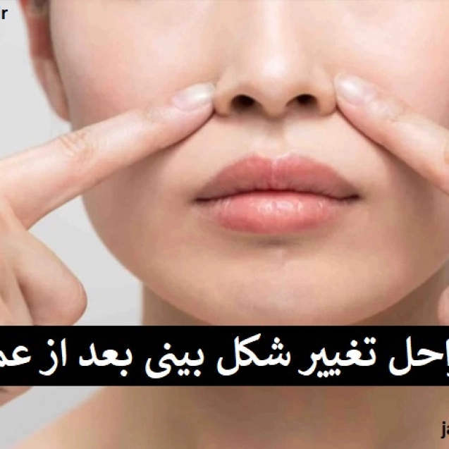 مراحل تغییر شکل بینی بعد از عمل