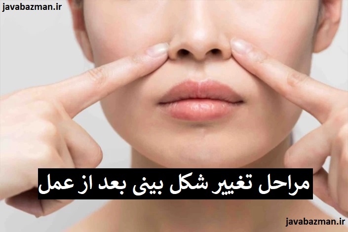 مراحل تغییر شکل بینی بعد از عمل